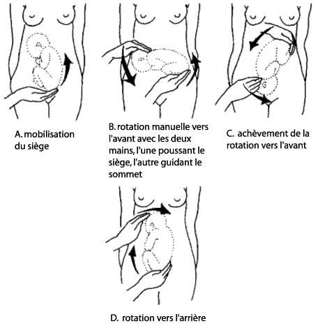 La Version Par Manœuvre Externe Vme Kinousses